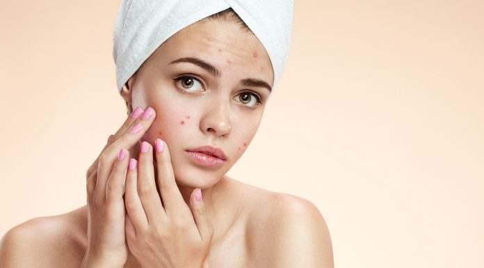 5 Skin Care Tips to Control Acne